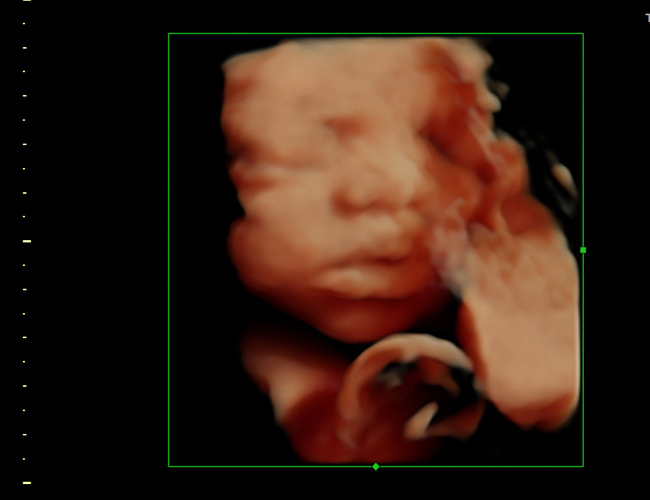 3D ultrasound image at 30 weeks